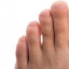 Как избавиться от гематомы под ногтем На ногтях больших пальцев ног появились синяки